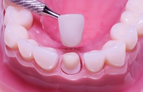 Dental_Crowns.jpg