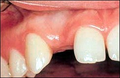 dental-implants2.jpg