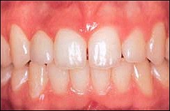 dental-implants3.jpg