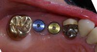 dental-implants4.jpg