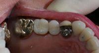 dental-implants5.jpg