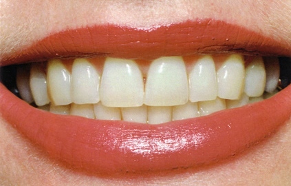 teeth_whitening_pic1.jpg