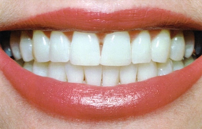teeth_whitening_pic2.jpg