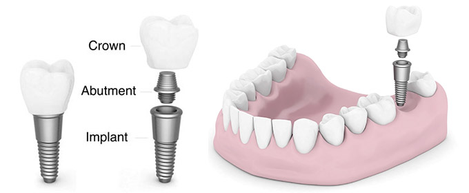 dental-implant.jpg