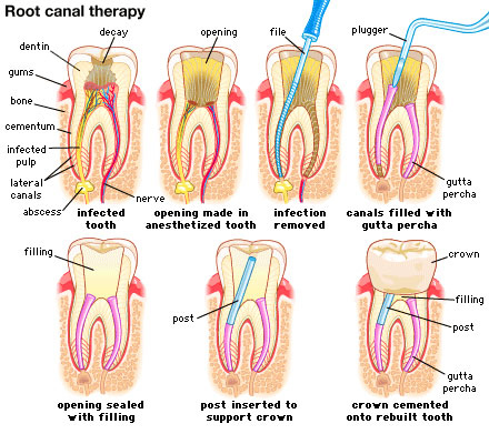 dt03182015142343rootcanaltherapy.jpg