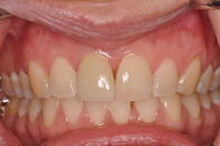 missing-tooth-restored-with-an-implant-crown-after.jpg