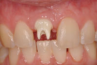 missing-tooth-restored-with-an-implant-crown.jpg
