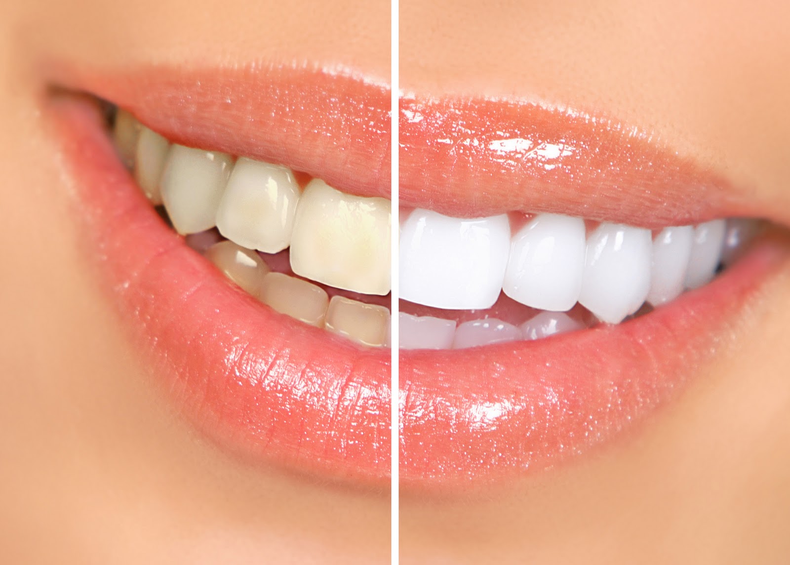 teeth-whitening.jpg