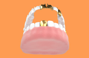 Dental-Crowns-300x195.jpg