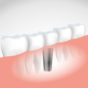 Implant-01-300x300.jpg