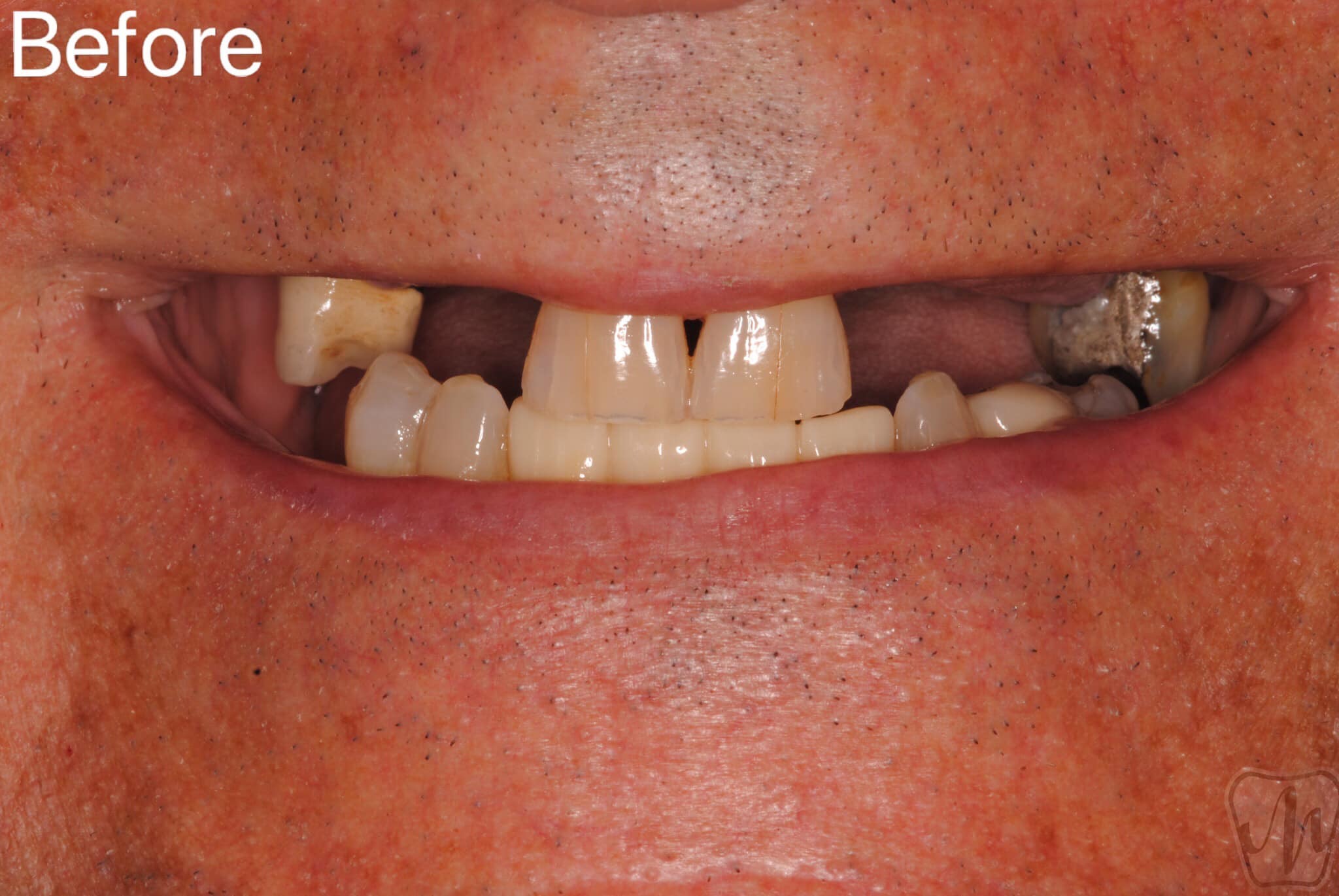 Modern Dental Smiles Dr Kurt O. Bally Implants