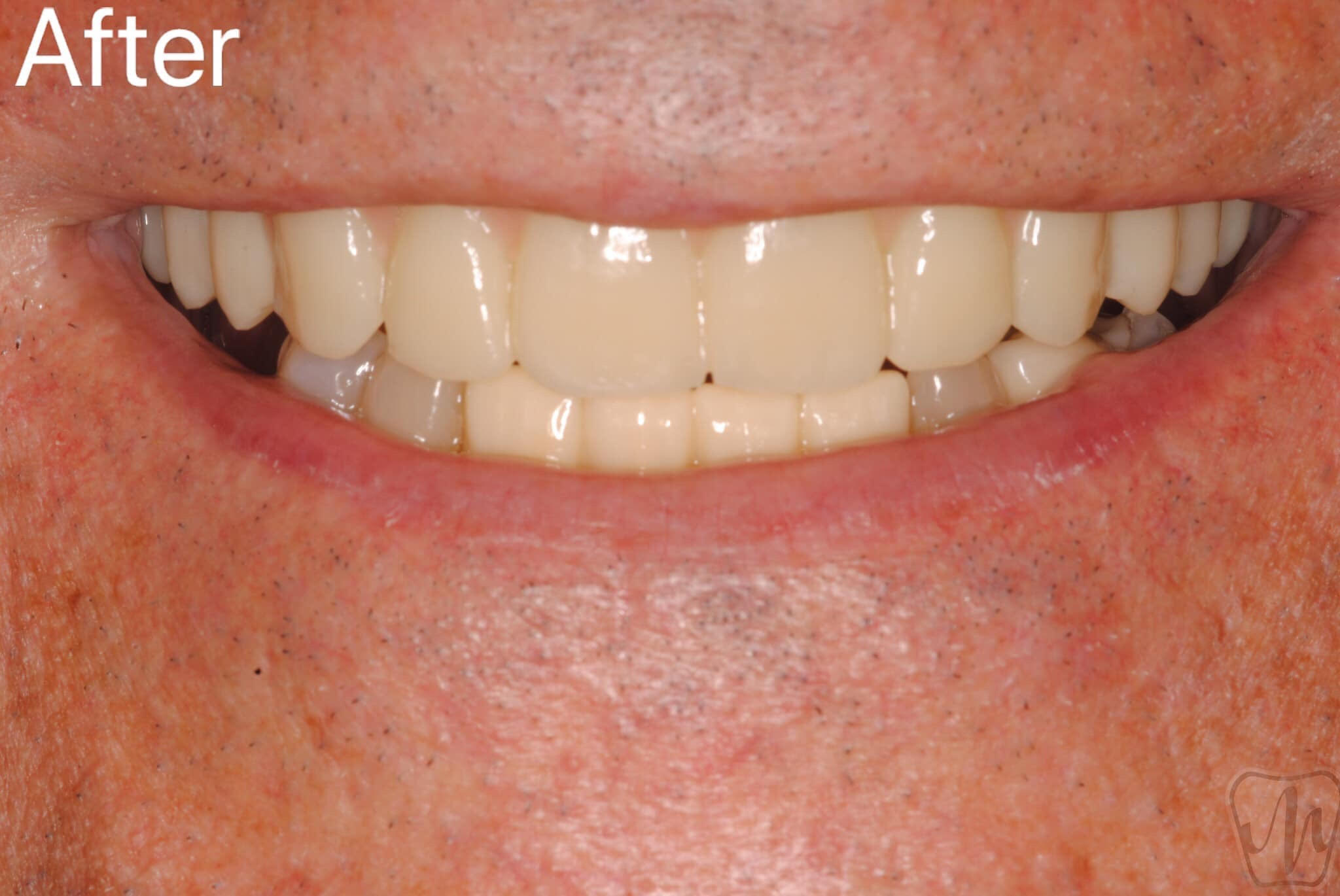 Modern Dental Smiles Dr Kurt O. Bally Implants