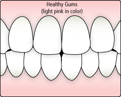 healthy_gums.gif