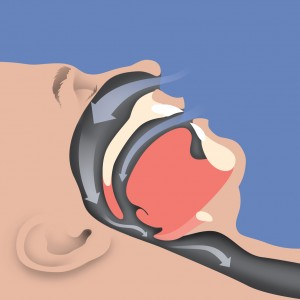 Sleep Apnea- Constricted Airway