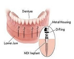 mini implants