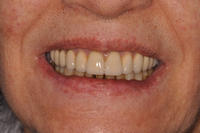 hopeless-teeth-periodontal-disease-after.jpg