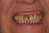 hopeless-teeth-periodontal-disease-before.jpg