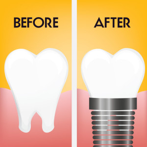 dentalimplant-300x300.jpg