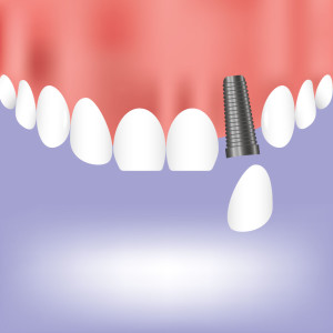 dentalimplant2-300x300.jpg