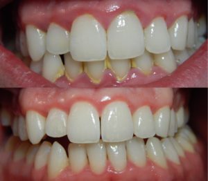 gum-disease-300x262.jpg
