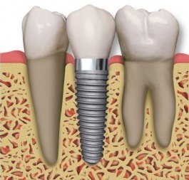 dental_implant.jpg
