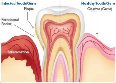 periodontal_gum_disease.jpg