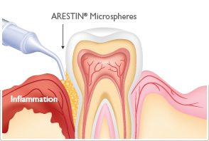 periodontal_gum_disease_treatment.jpg