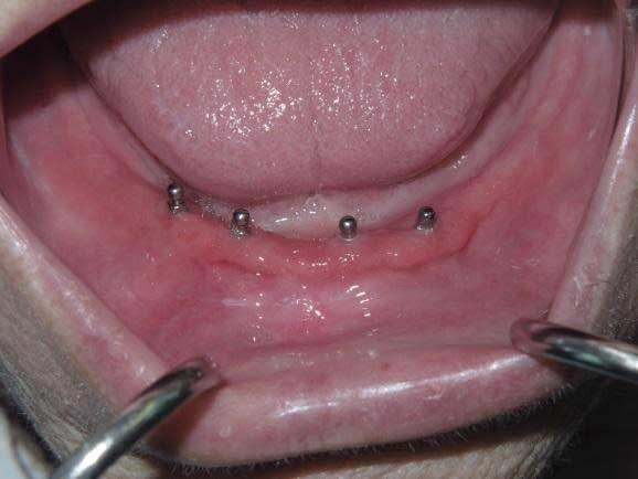 mini_dental_implants_3.jpg