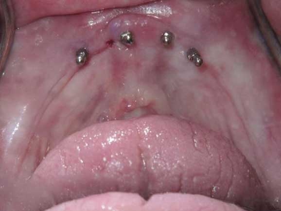 mini_dental_implants_4.jpg