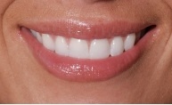 Dental Crowns by Yavner Dental Associates in Medford, MA